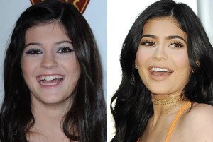 Kylie-Jenner-antes-y-después-carillas-min