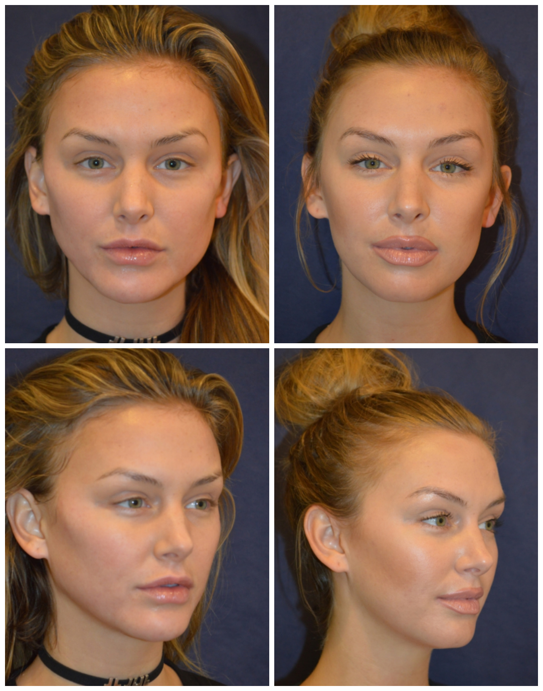 Lala Kent, before and after her treatments with Dr. Diamond.