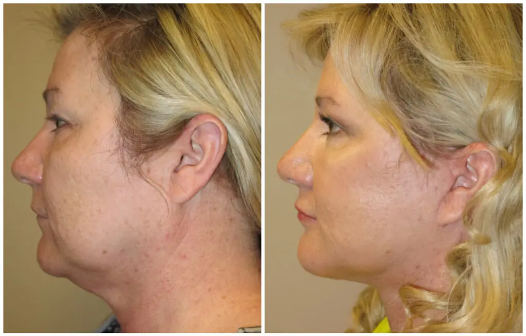 face and neck lift