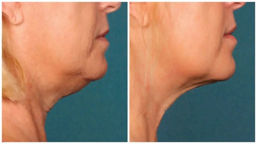 kybella, before and after