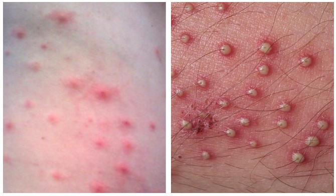 Folliculitis