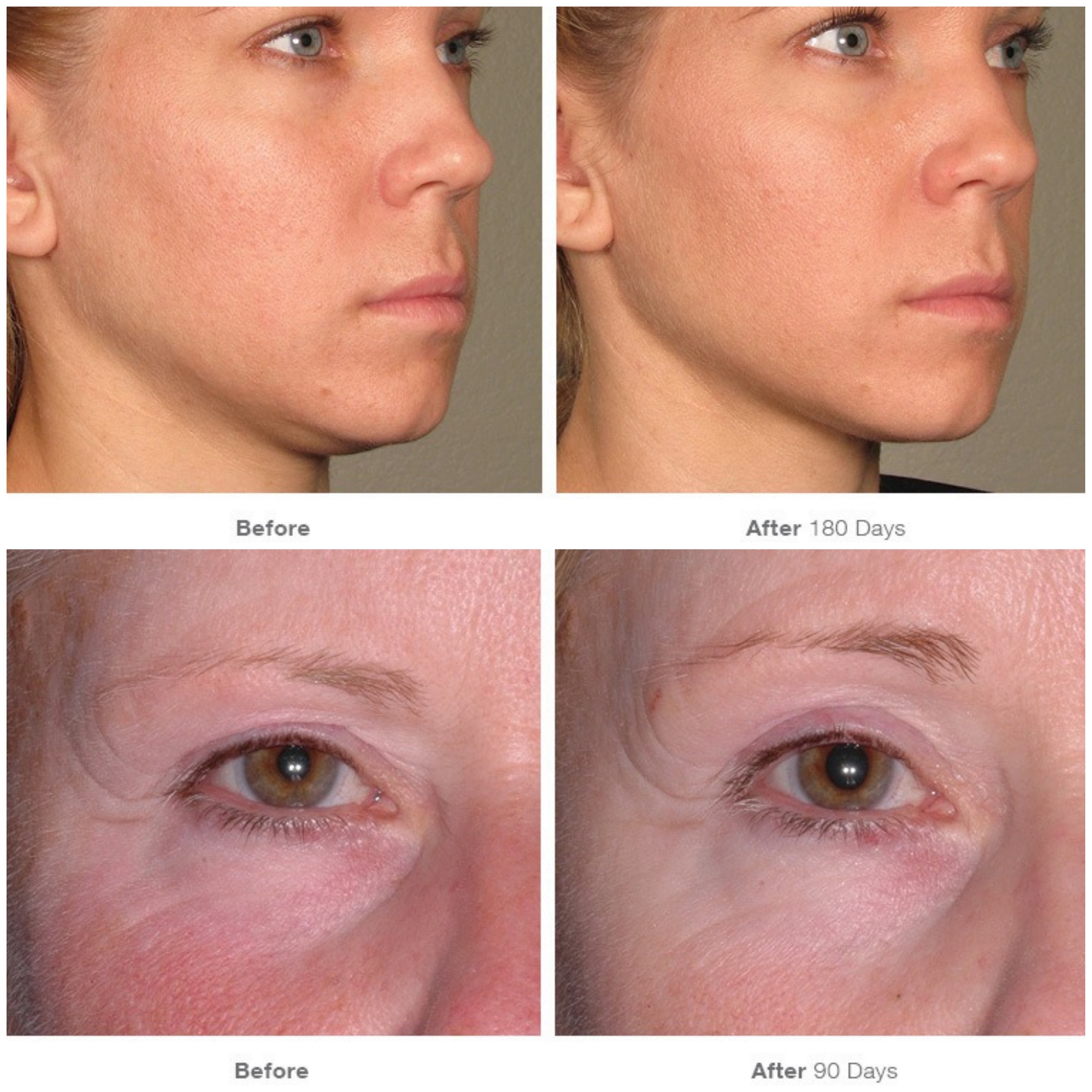 Ultherapy Before & Afters