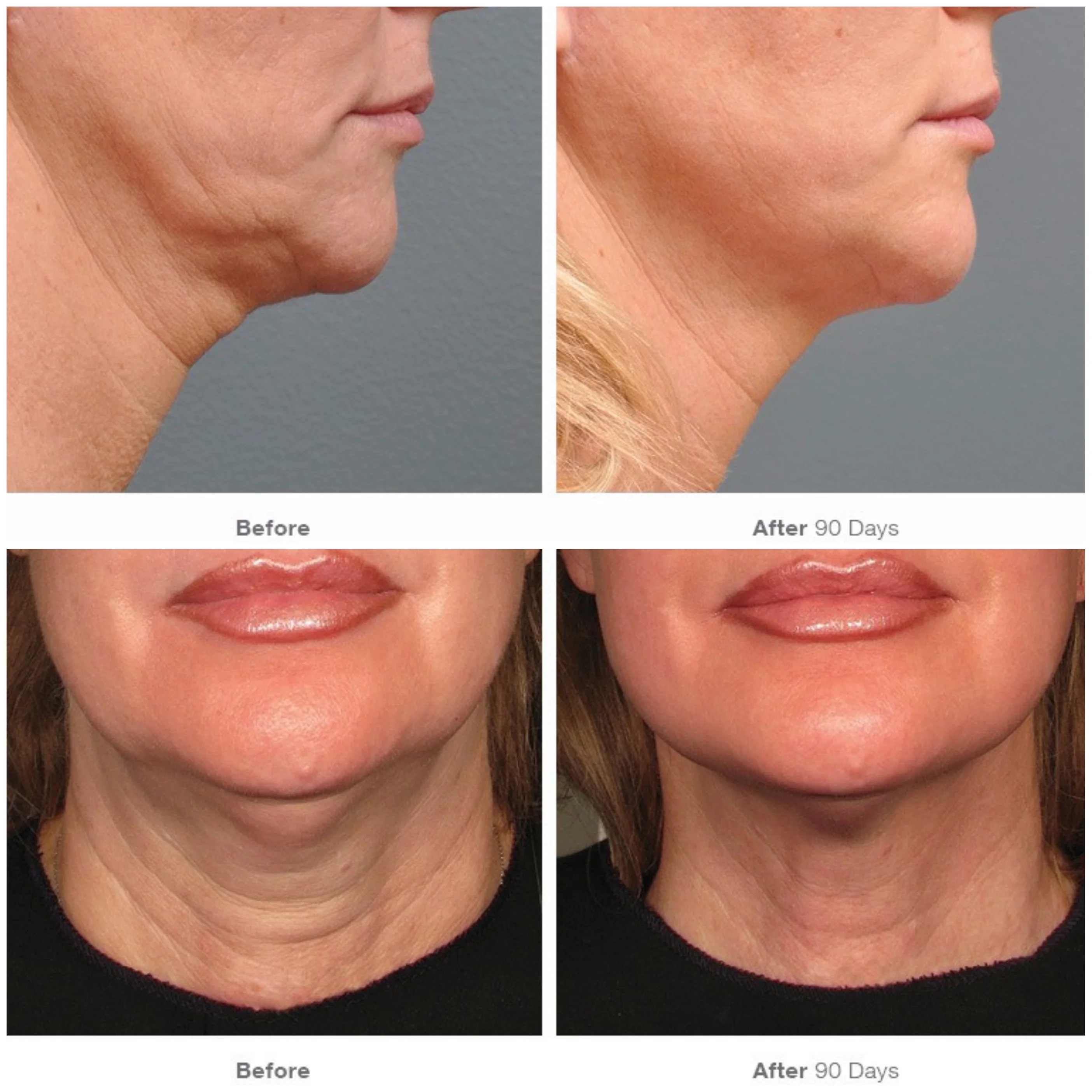 Ultherapy Before & After