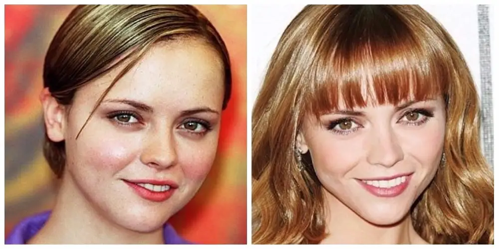 Christina Ricci, before and after plastic surgery.