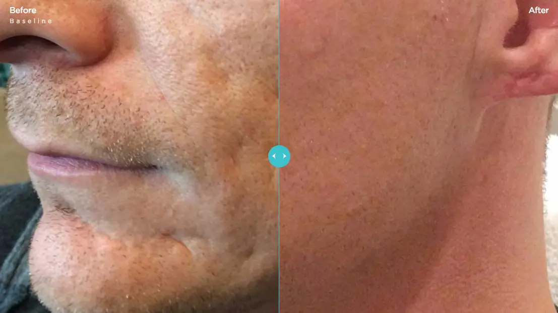 Bellafill Acne Scars Before & After