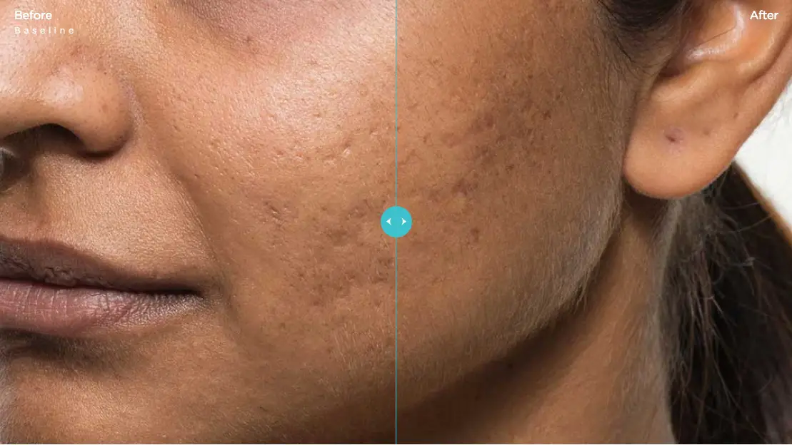 Bellafill Acne Scars Before & After