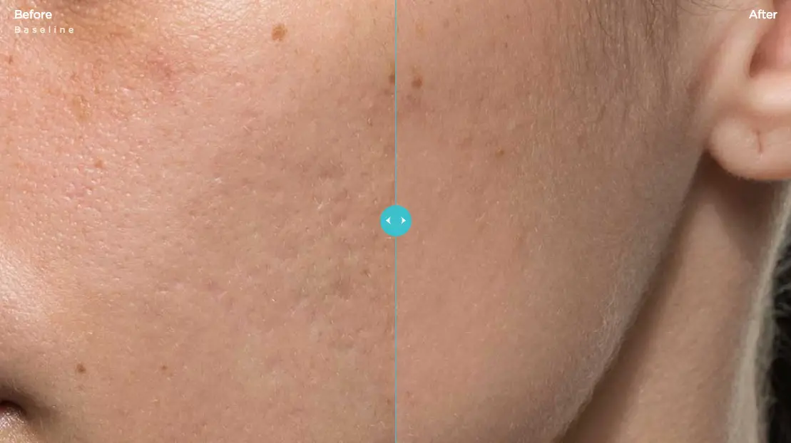 Bellafill Acne Scars Before & After