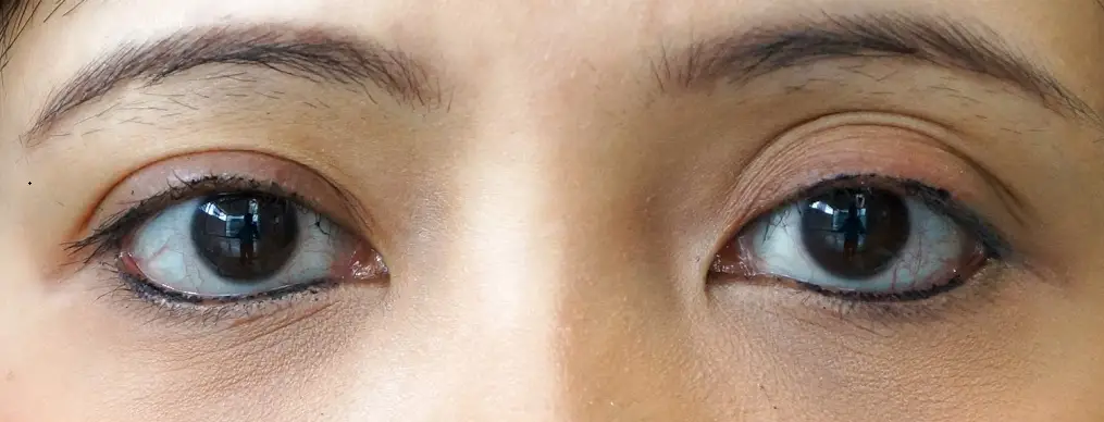 triple eyelid crease