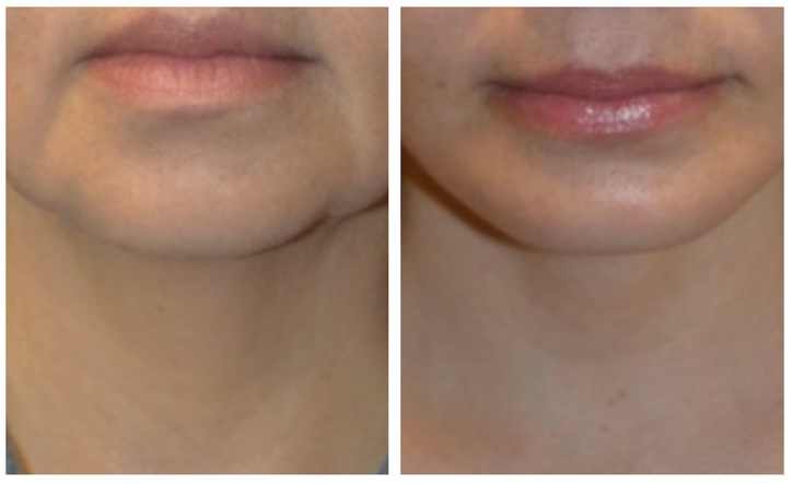 Chin implant surgery