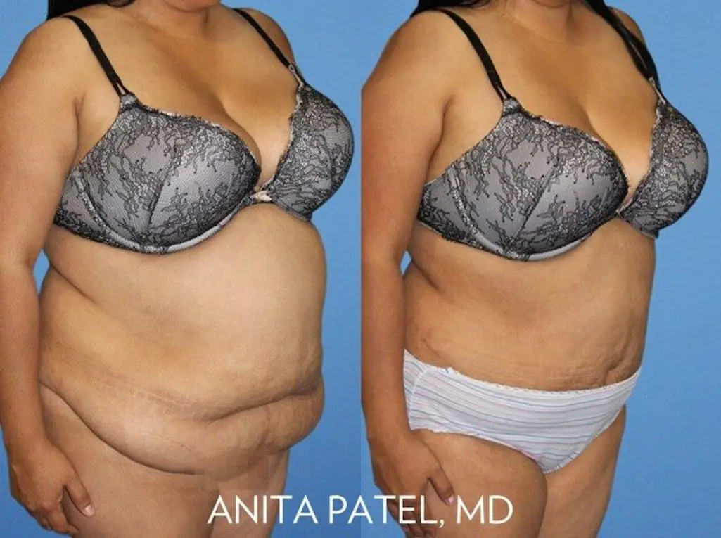 Panniculectomy FUPA