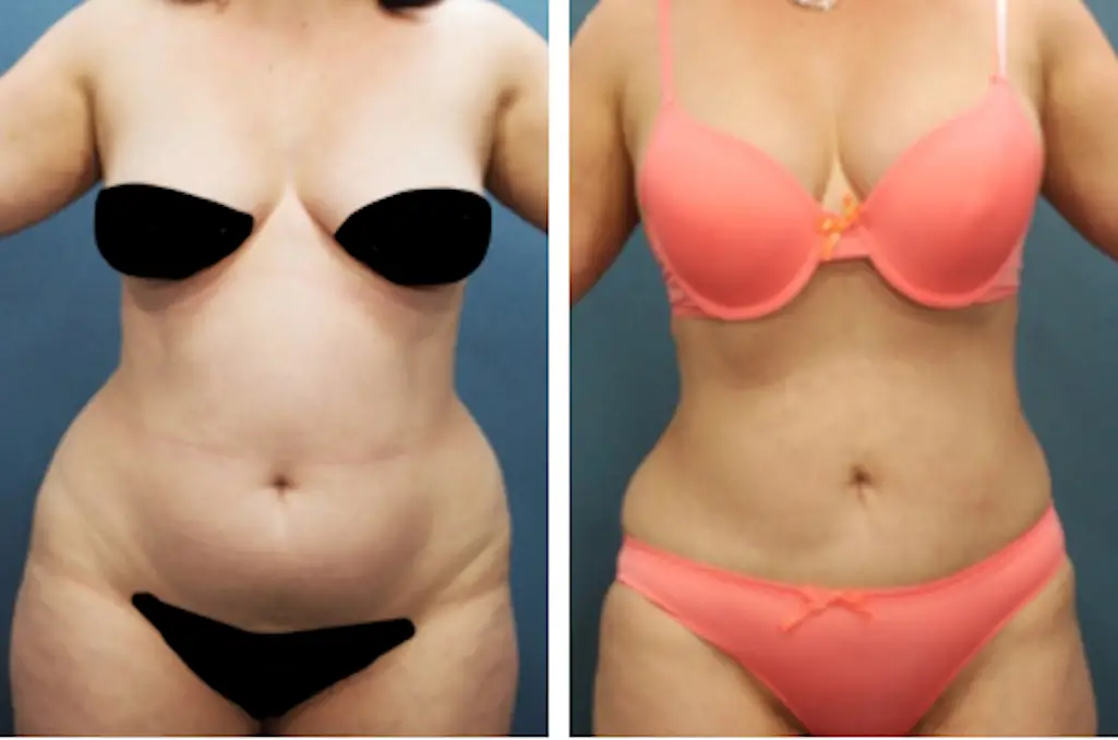 Pubic Liposuction FUPA